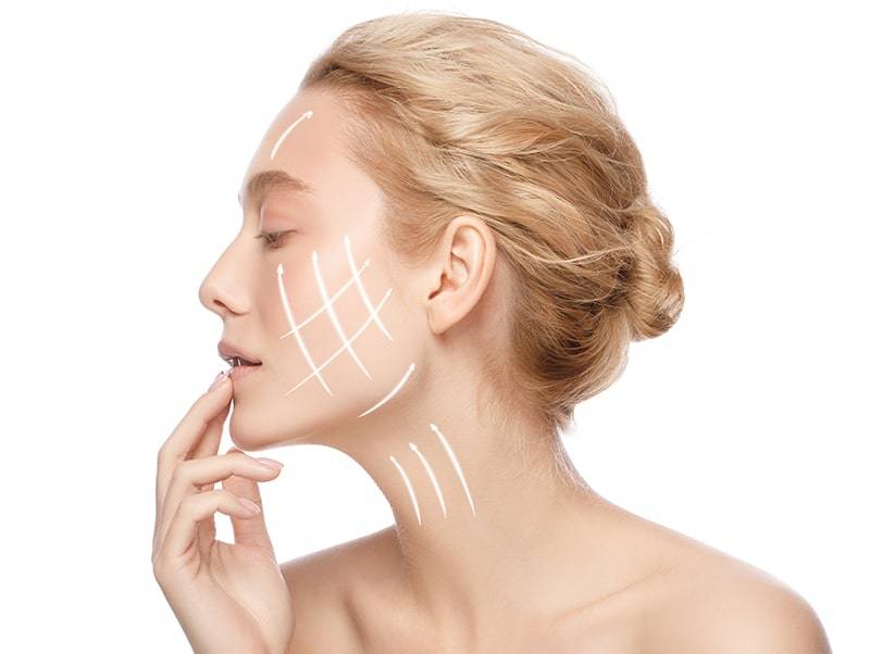 Pfeilmarkierung im Gesicht einer Frau als Beispiel für ein Fadenlifting